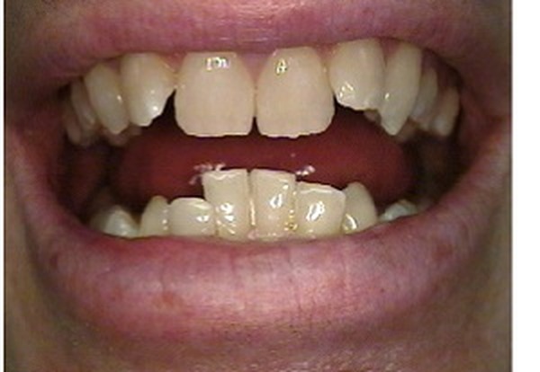Dentadura desalineada antes del tratamiento de ortodoncia